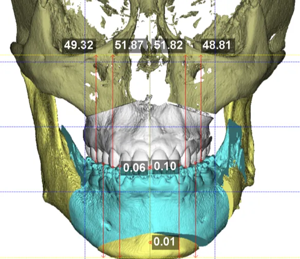Planejamento digital 3D do perfil facial para cirurgia ortognática